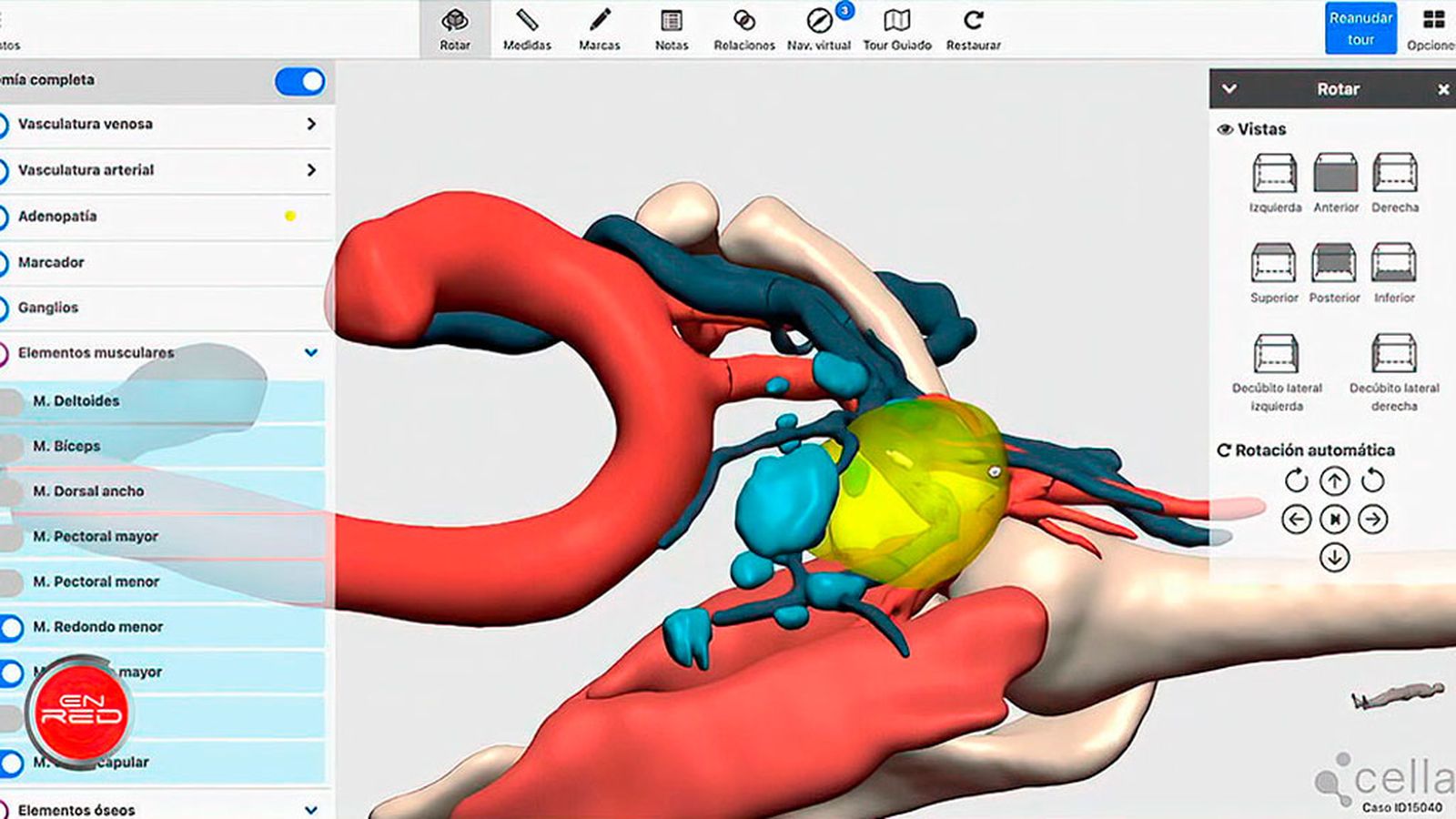 Planificación en 3D para la cirugía del melanoma metastásico