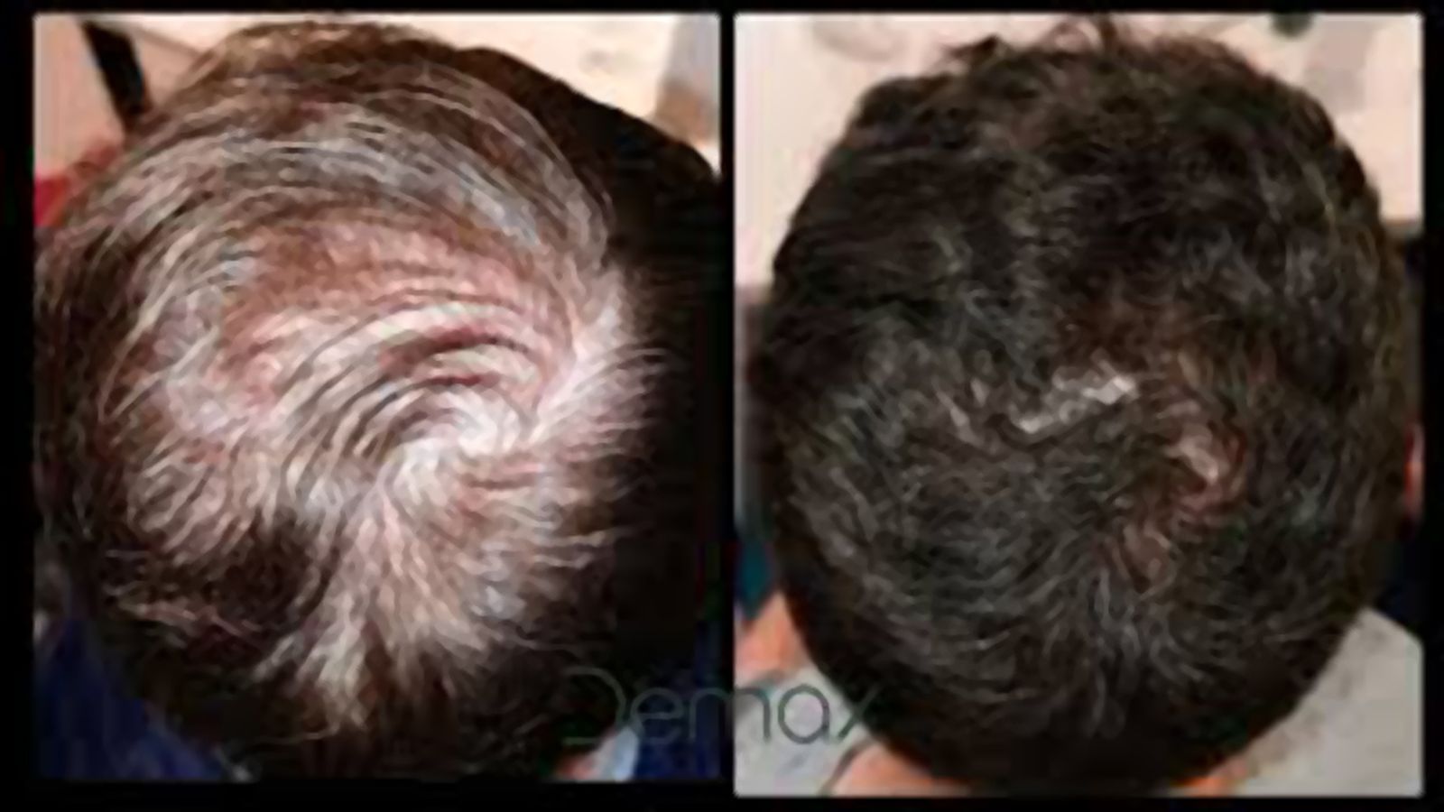 enrique alopecia