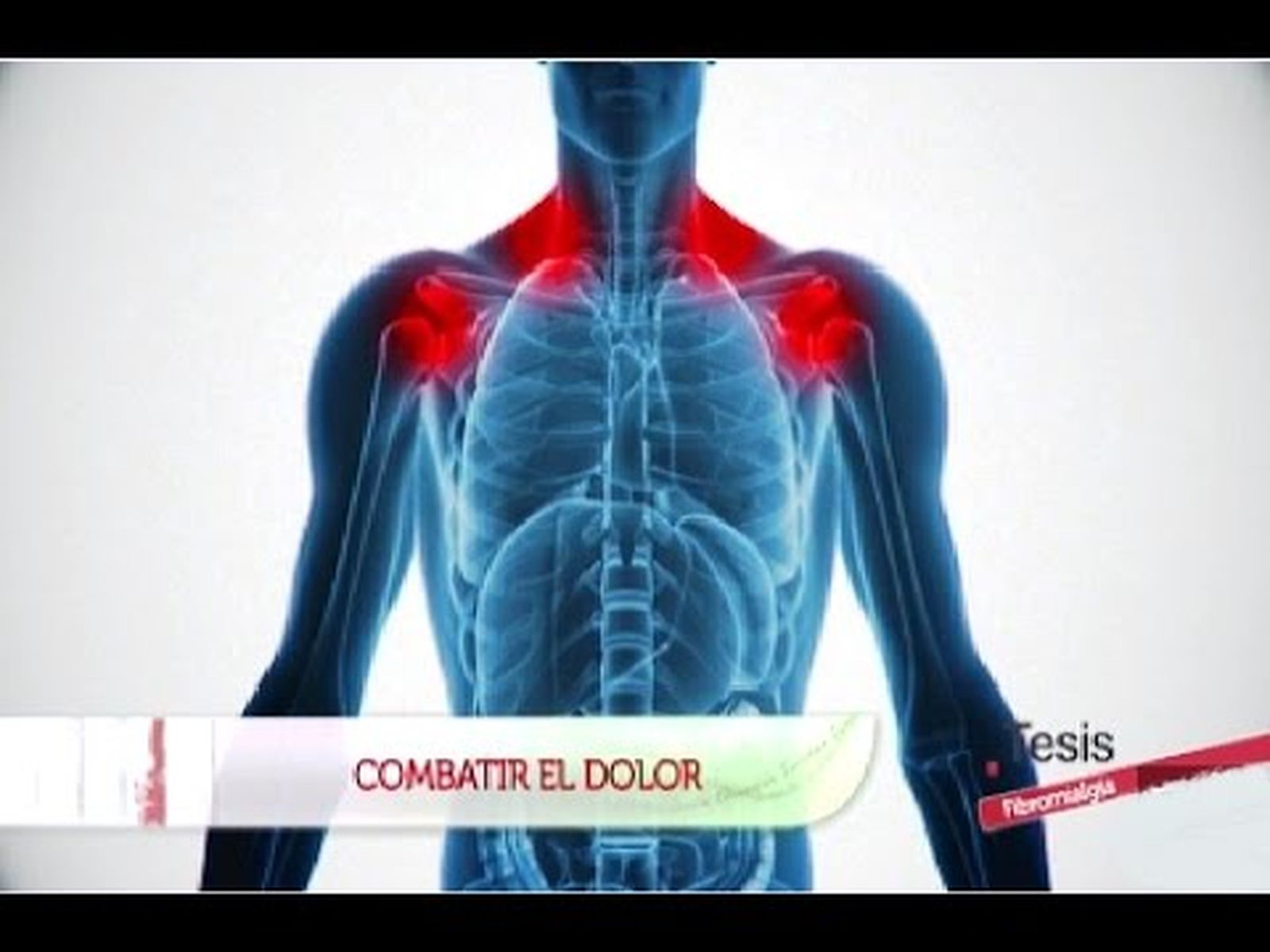 Fibromialgia y Síndrome de la fatiga crónica