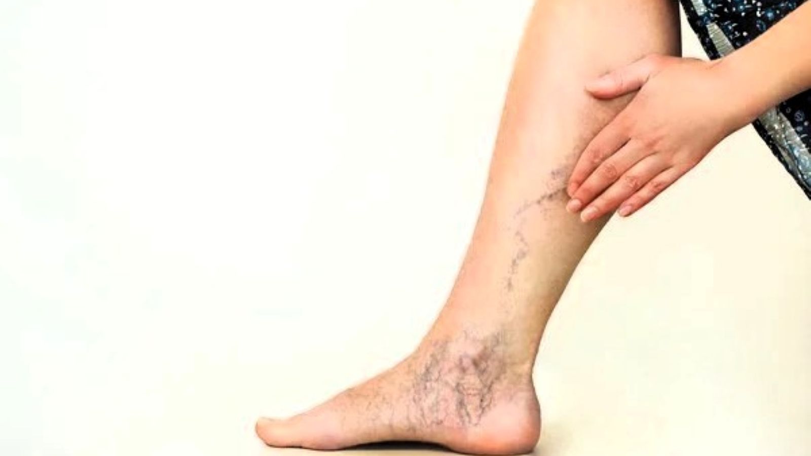 varices