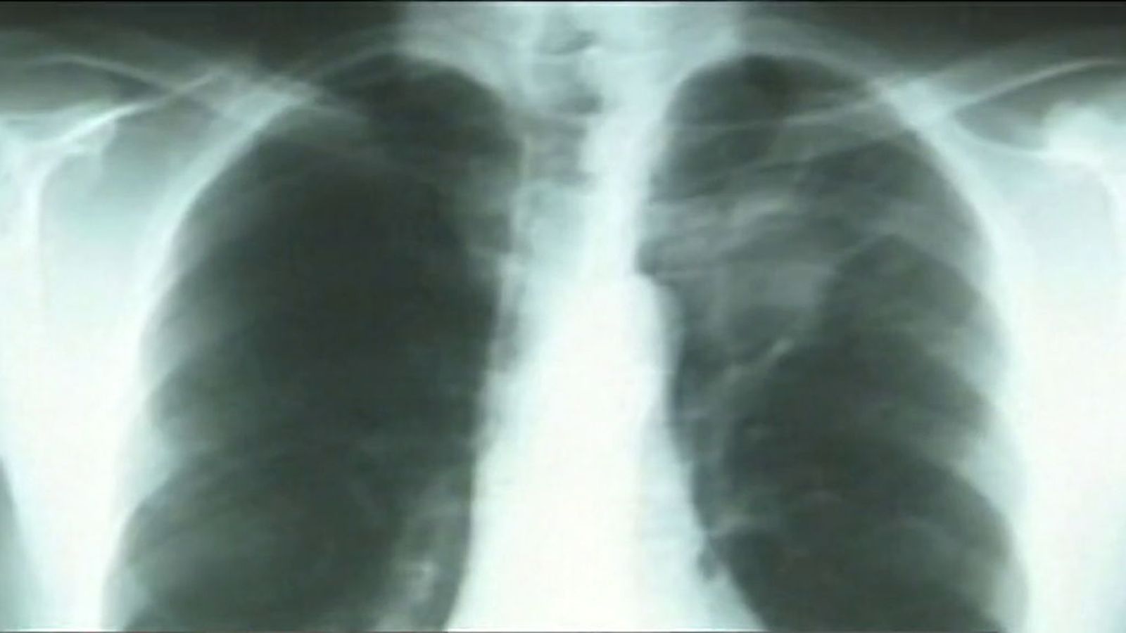 pulmones