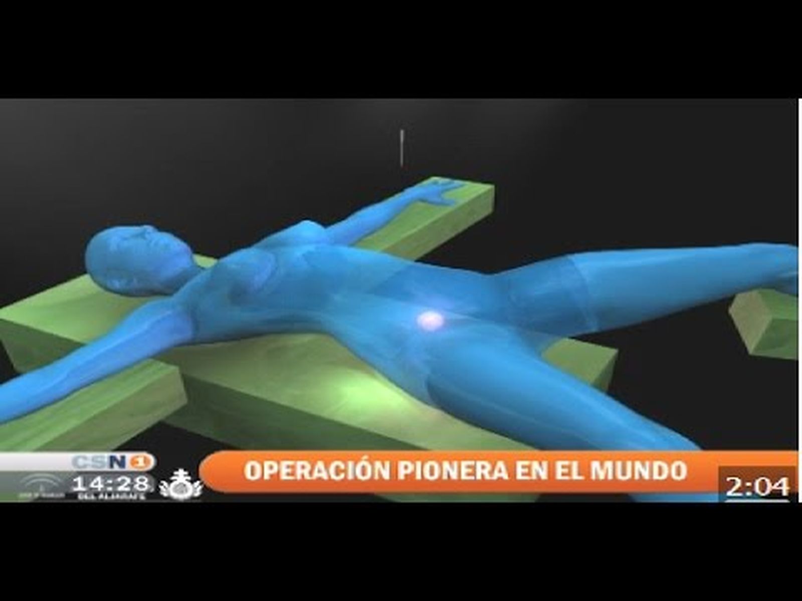 Primera intervención de cáncer de colon por vía vaginal: operación pionera en el mundo