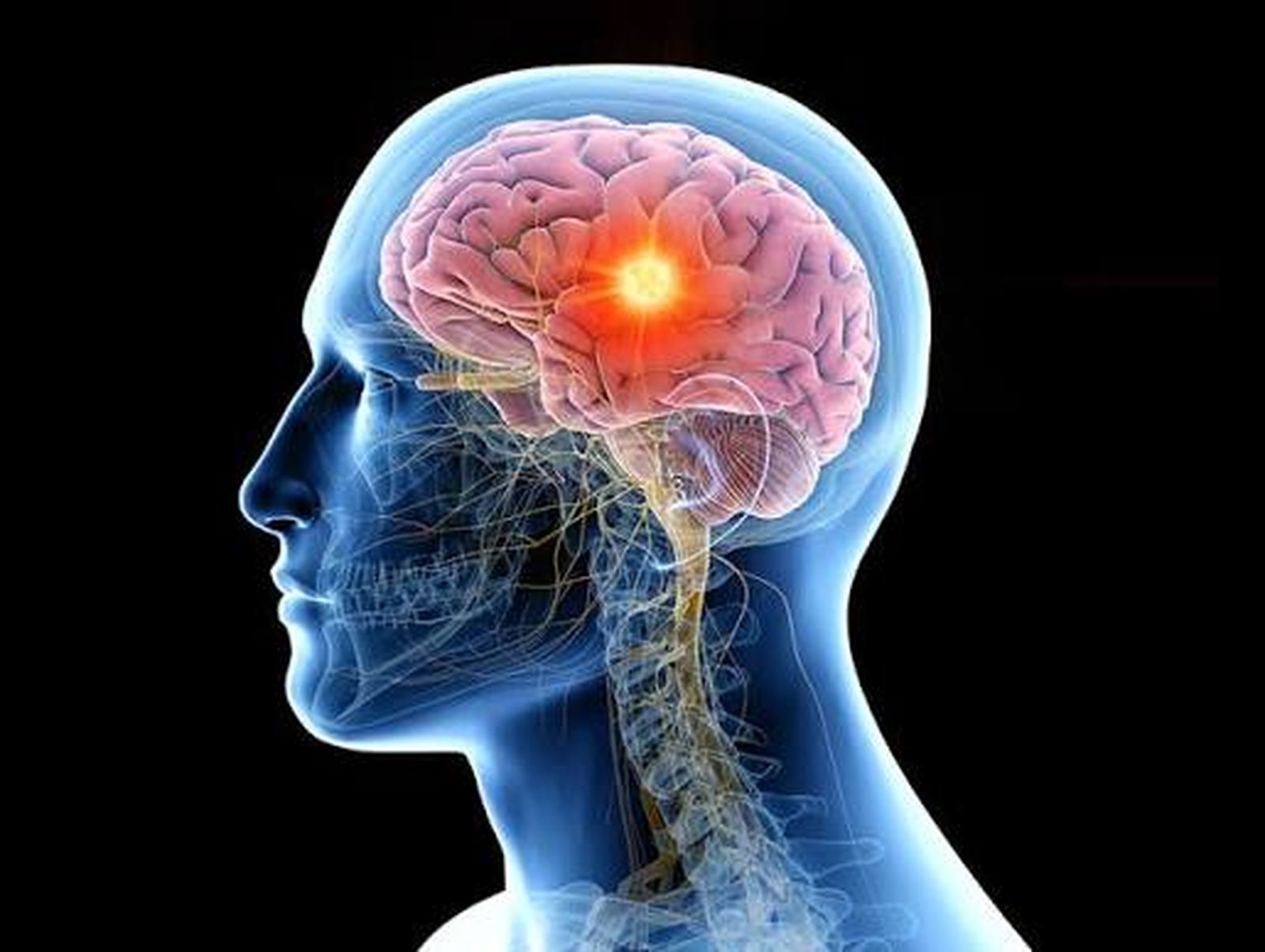 Metástasis cerebral
