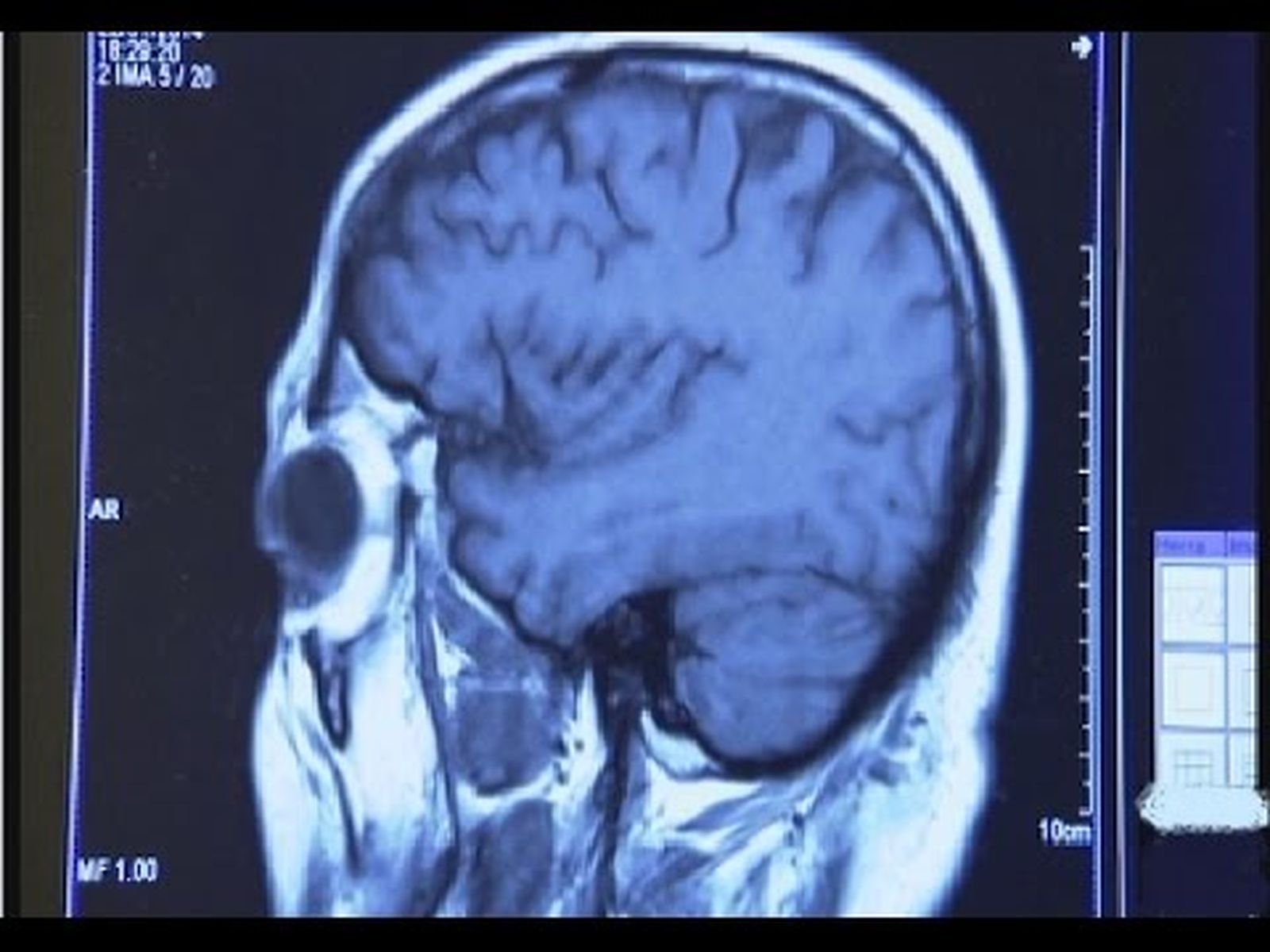 Enfermedad de Parkinson