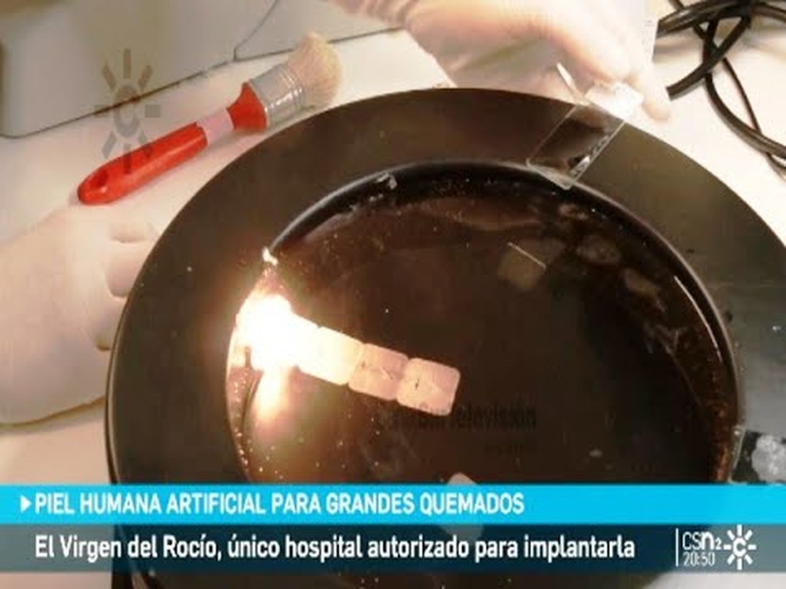 Piel humana artificial: el Hospital Virgen del Rocío de Sevilla es autorizado para implantar piel