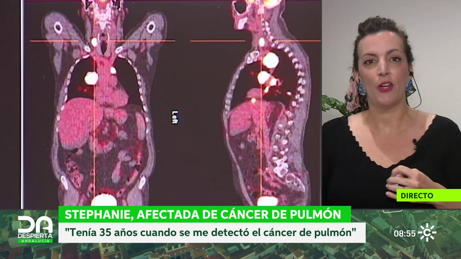 Stephanie da Rocha, afectada por cáncer de pulmón