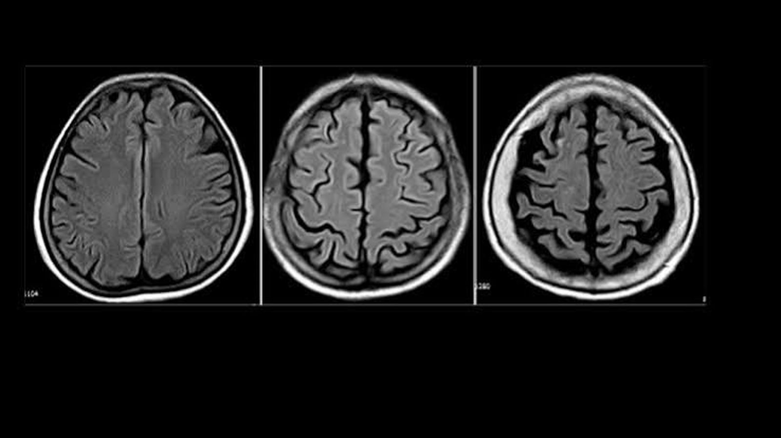 Distrofia cerebral
