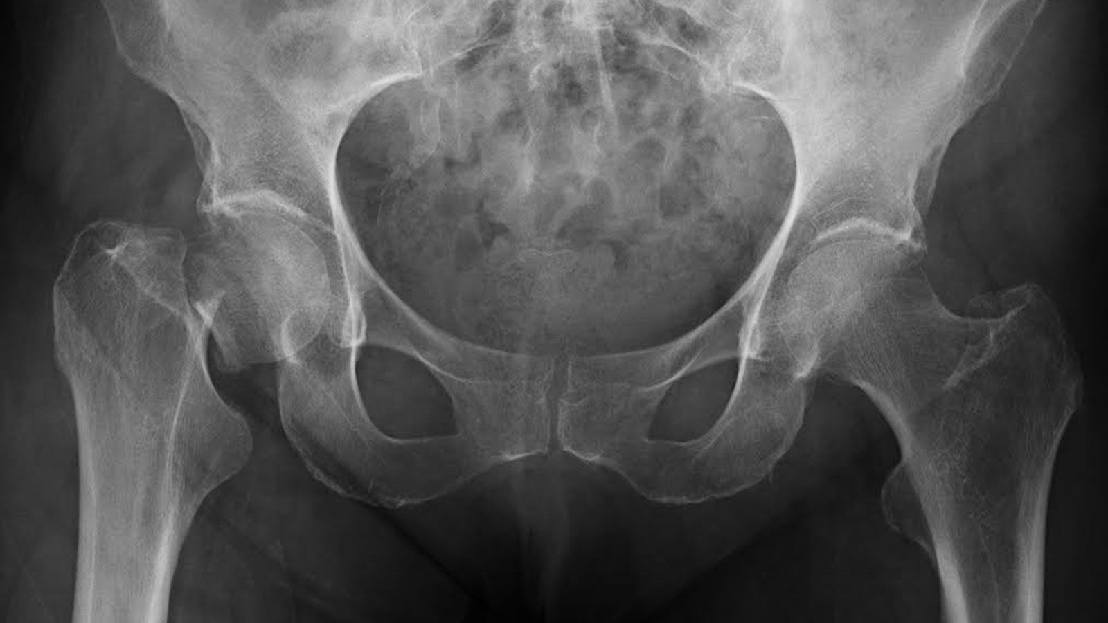 EuropaPress_1311497_descubren_dos_biomarcadores_identifican_riesgo_osteoporosis_fractura_osea