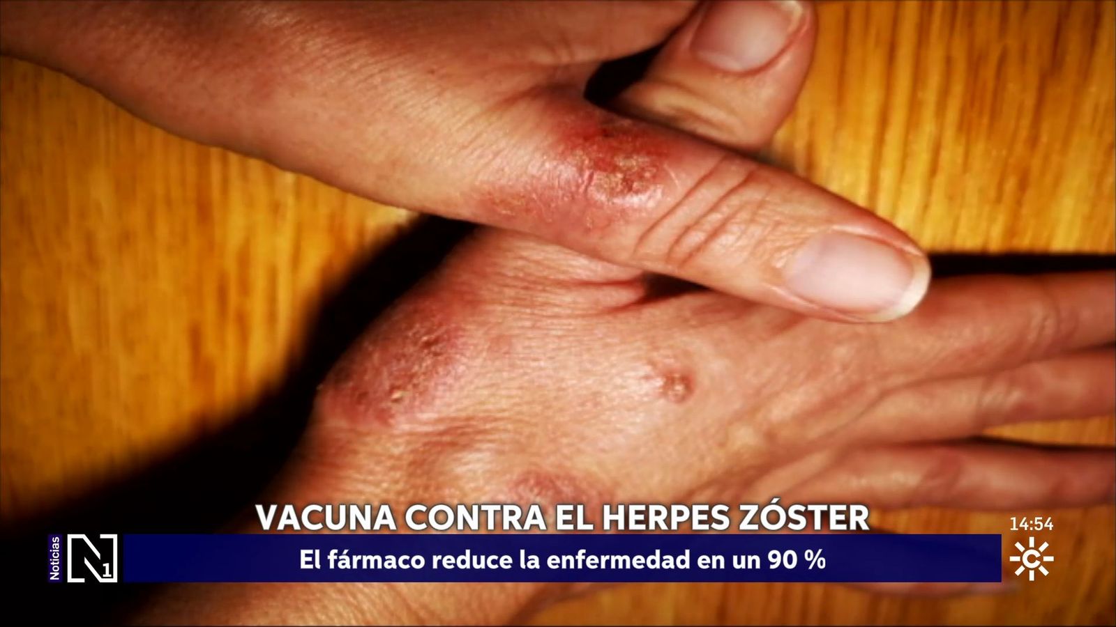 Vacuna contra el Herpes Zóster